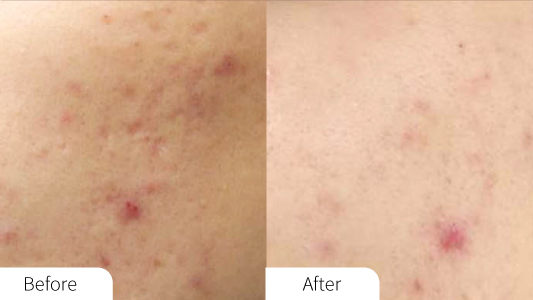 Hermia Aquapure Before and After