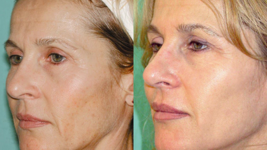 Hermia Dermaceutic  Cosmo Peel Before and After