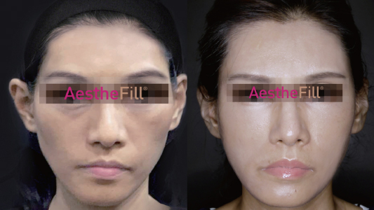 Hermia AestheFill Before and After