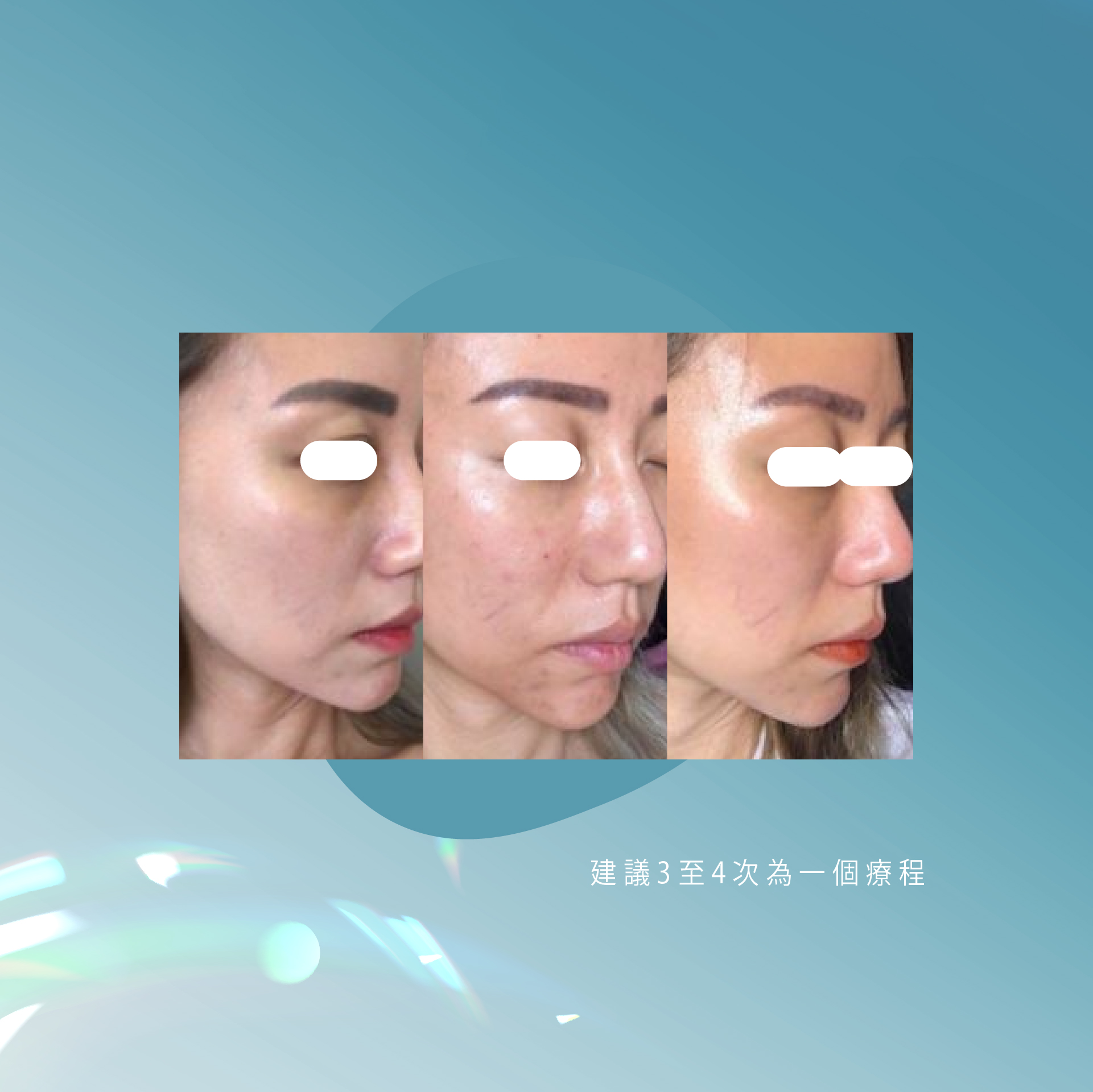 Rejuran Healer麗珠蘭 Before and After 效果