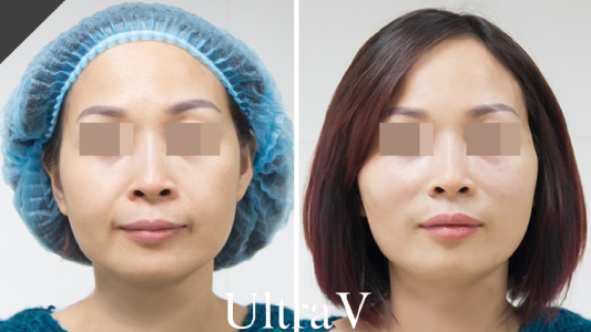 Ultracol PDO 液態埋線 Before and After 效果