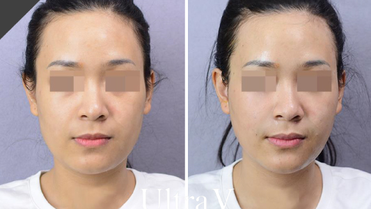 Ultracol PDO 液態埋線 Before and After 效果