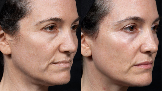 Hermia Thermage Flx Before and After